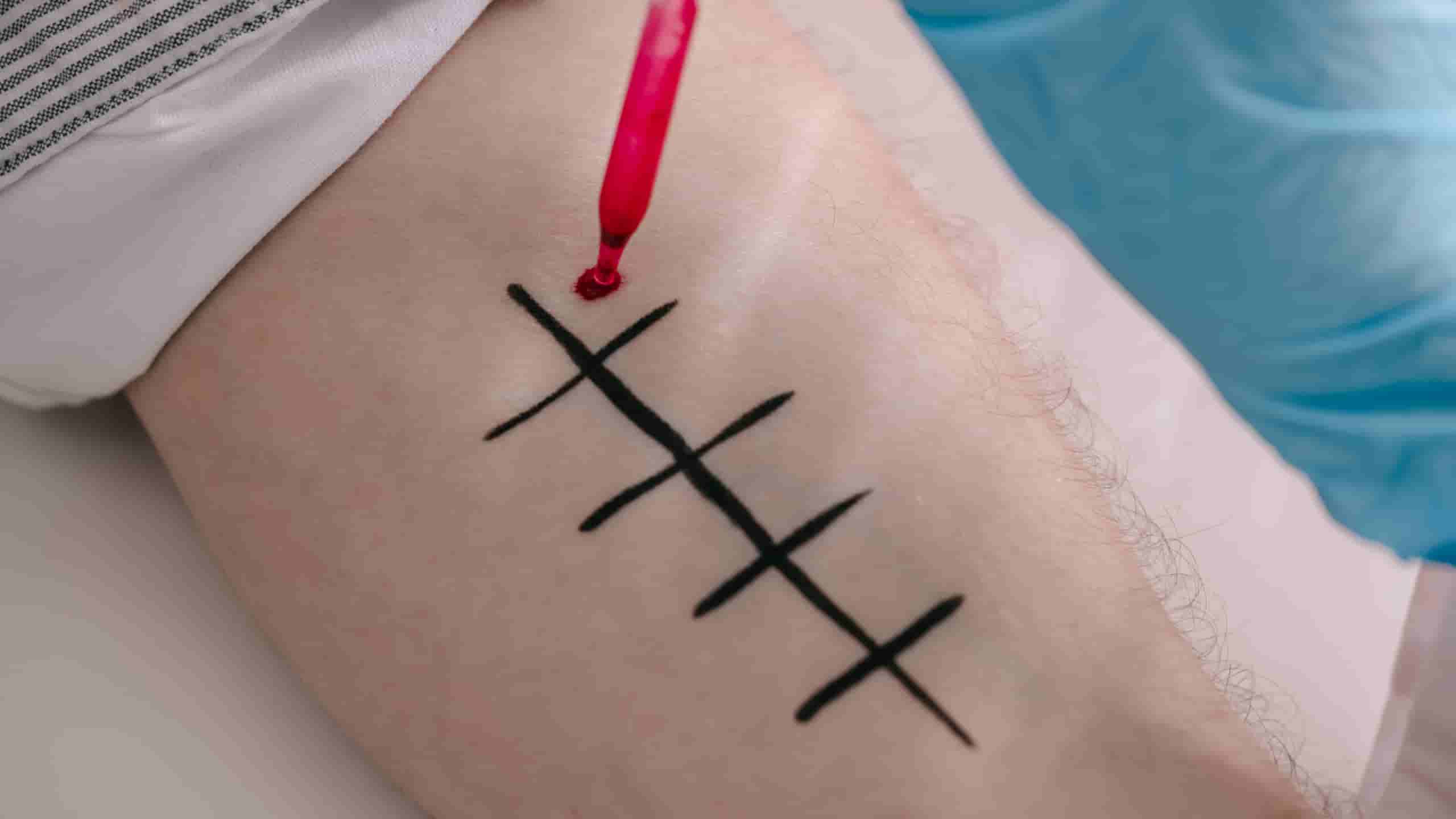 What is the success rate of treatments at skin clinics in Hobart?