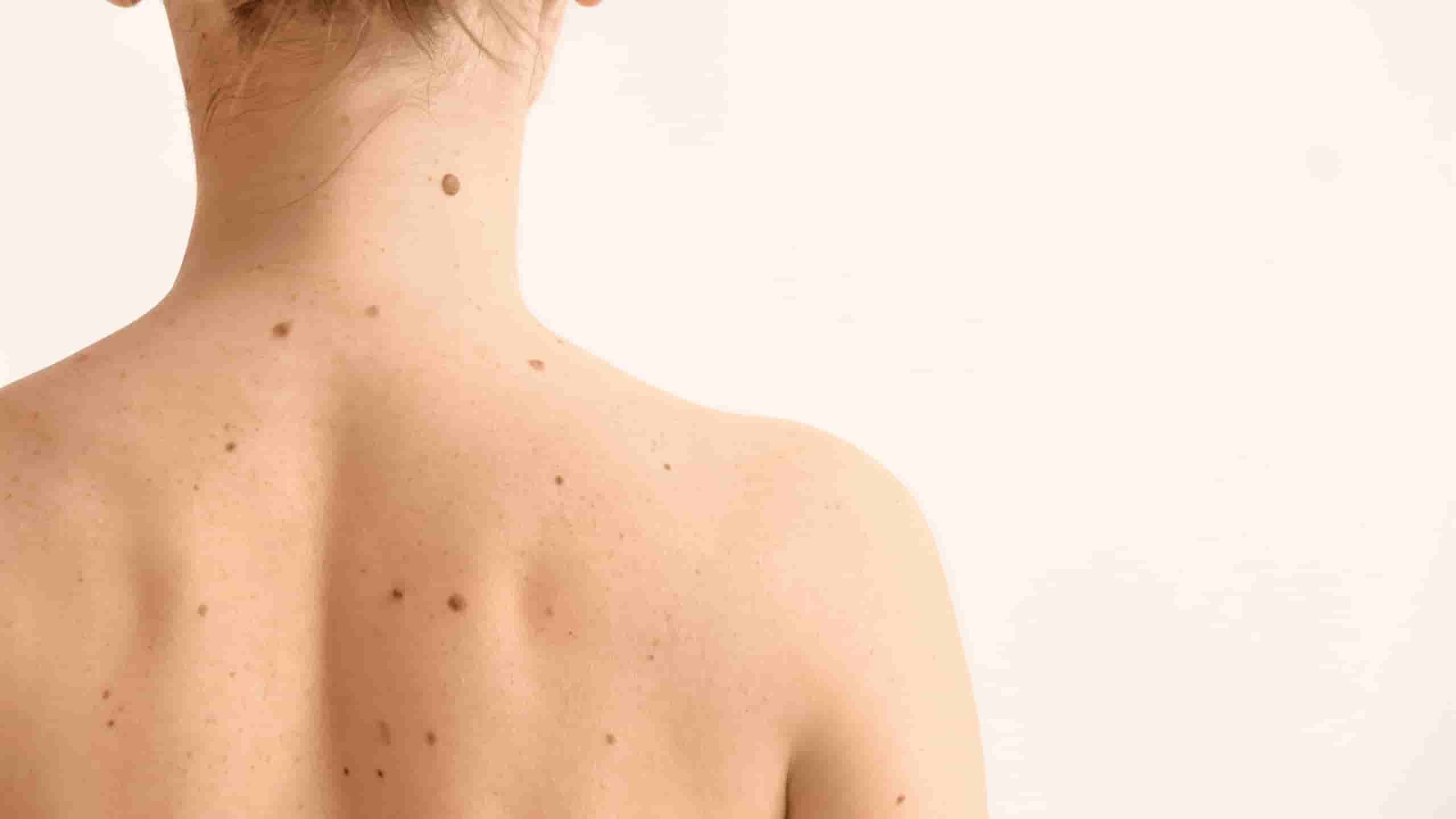 How to Achieve Clearer Skin with Professional Help in Hobart